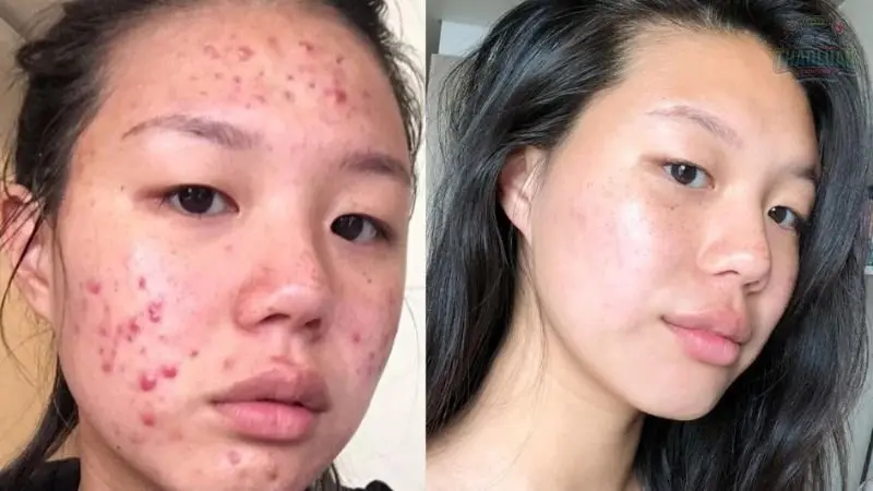 13 cách trị mụn tại nhà hiệu quả 7