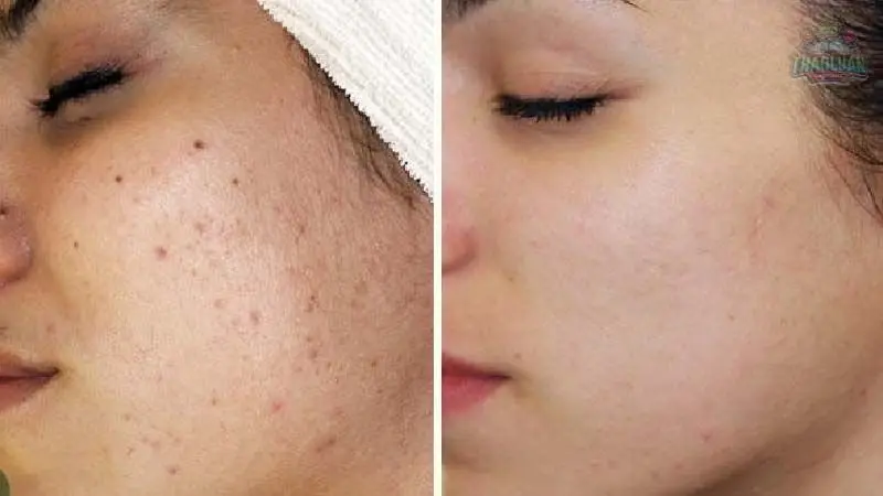 Đặc điểm và lợi ích khi trị mụn 2
