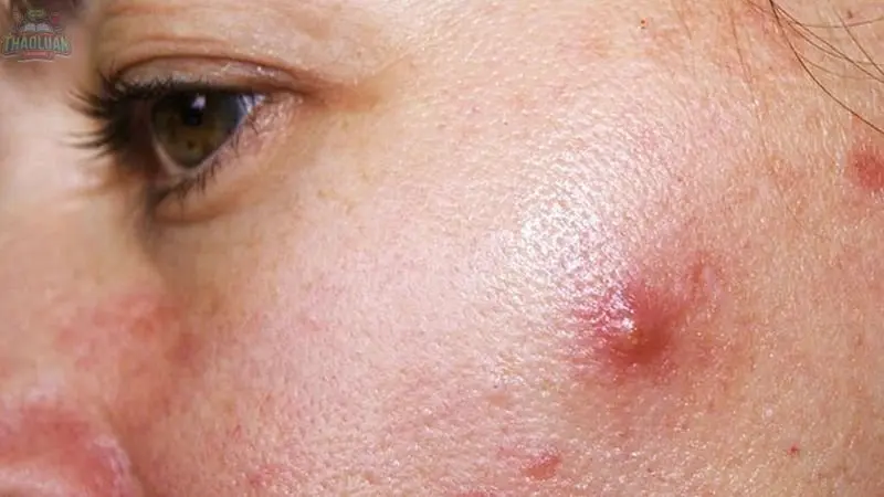 Nguyên nhân gây mụn đỏ 2 bên má 2