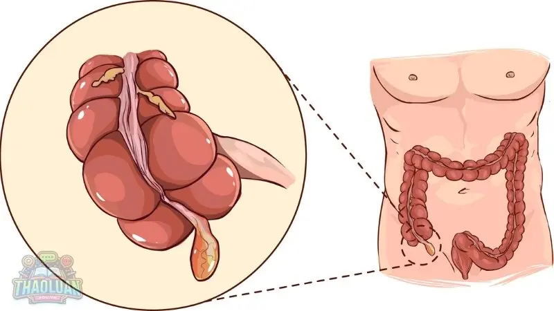 10 Cách nhận biết đau ruột thừa bạn nên biết sớm 