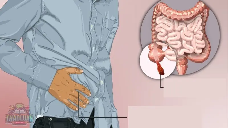 Cơn đau ruột thừa biểu hiện như thế nào?