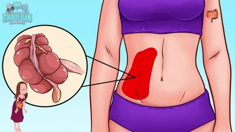 Biến chứng của phẫu thuật cắt ruột thừa