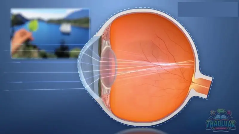 Nguyên nhân gây ra loạn thị