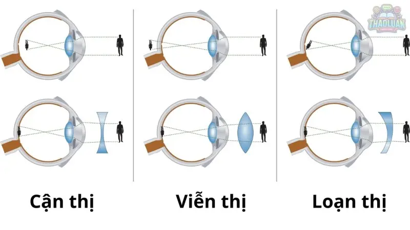 Loạn thị khác với cận thị như thế nào?