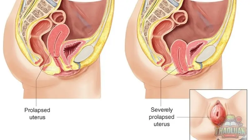 Cách nhận biết sa tử cung bằng tay Cách nhận biết sa tử cung bằng tay