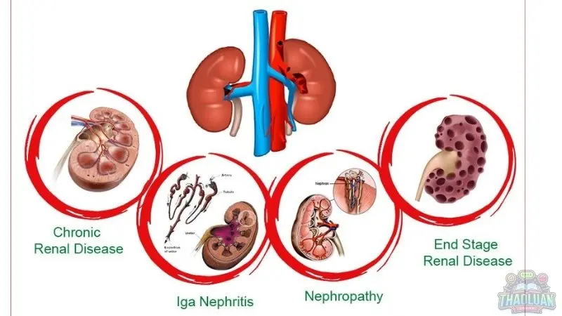 Nguyên nhân gây bệnh thận Nguyên nhân gây bệnh thận