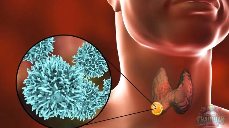 Ung thư tuyến giáp là gì?