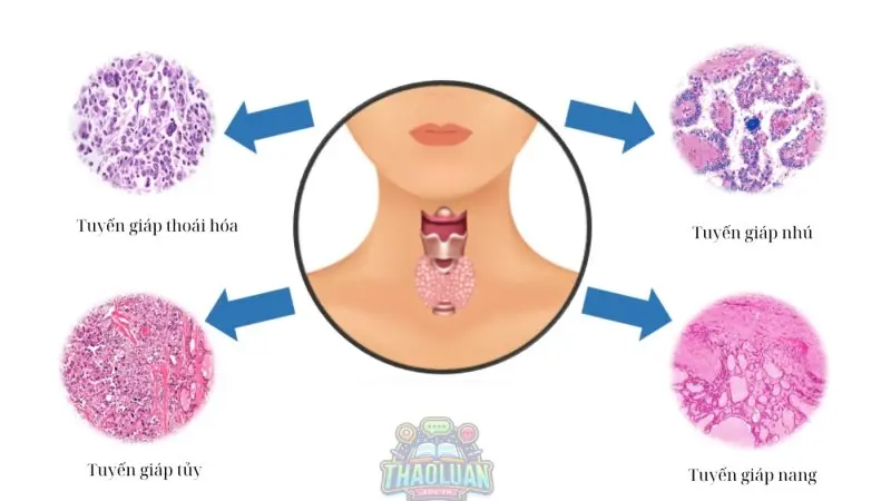 Có những loại ung thư tuyến giáp nào?