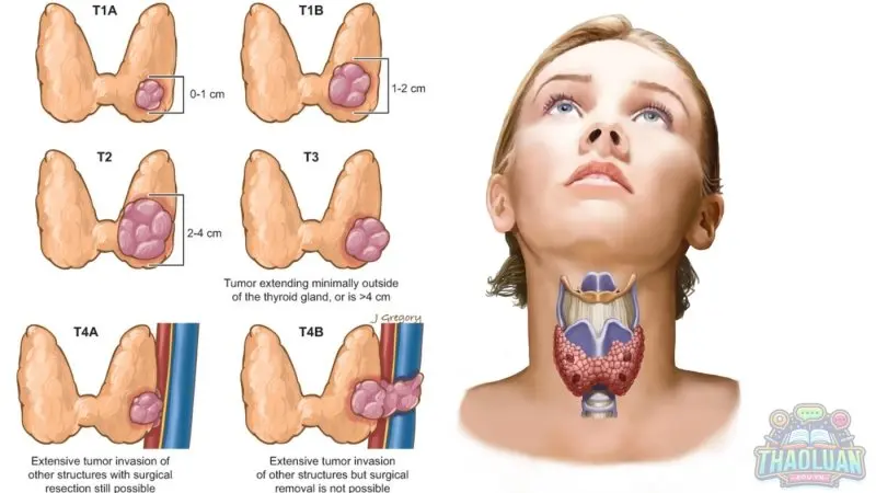 Các giai đoạn ung thư tuyến giáp