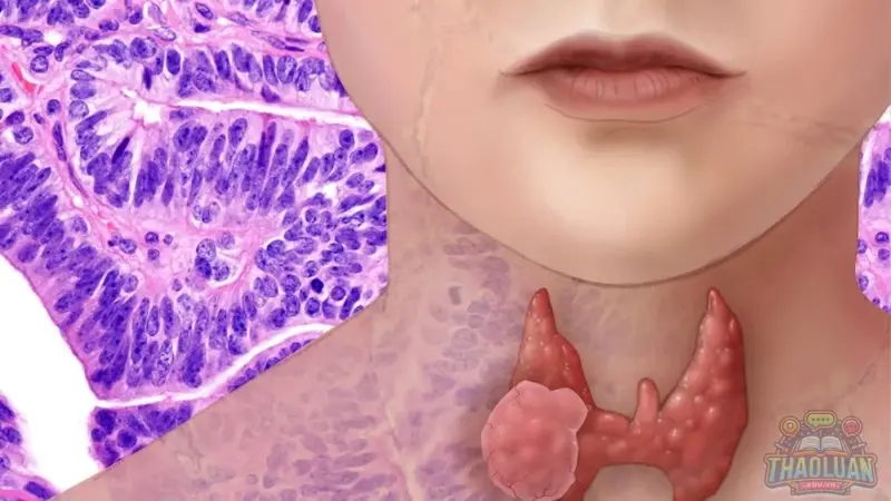 Biến chứng của ung thư tuyến giáp