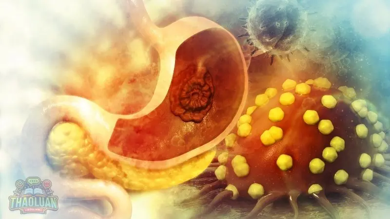 Nguyên nhân gây ung thư dạ dày