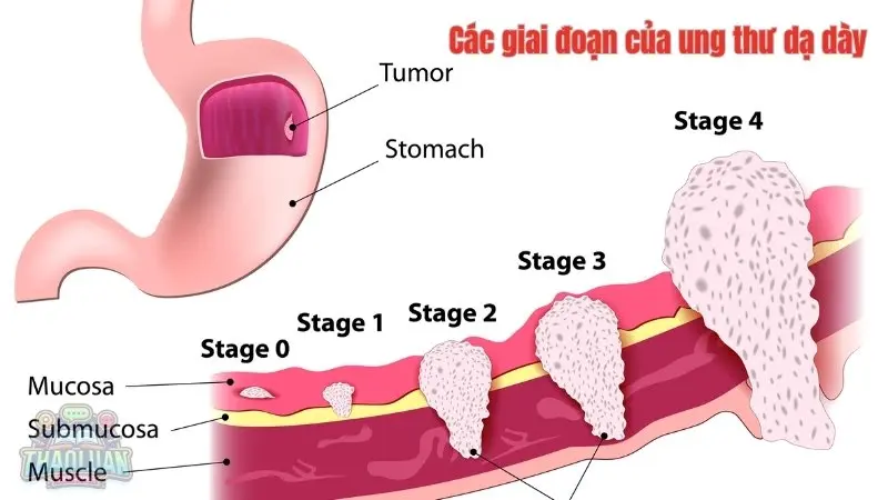 Các giai đoạn của ung thư dạ dày