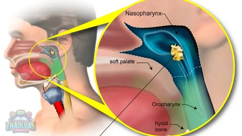 Nguyên nhân gây ung thư vòm họng