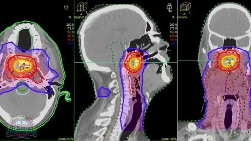 Ung thư vòm họng là gì?
