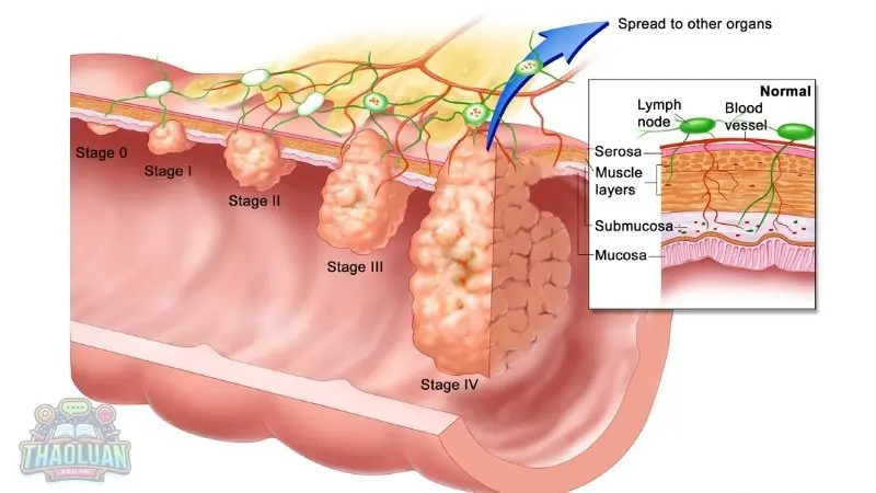 Các giai đoạn của ung thư vòm họng