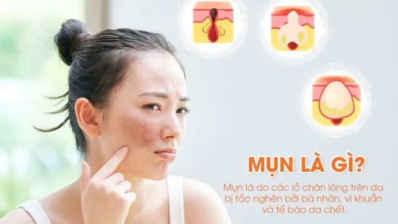Mụn ẩn là gì? 1
